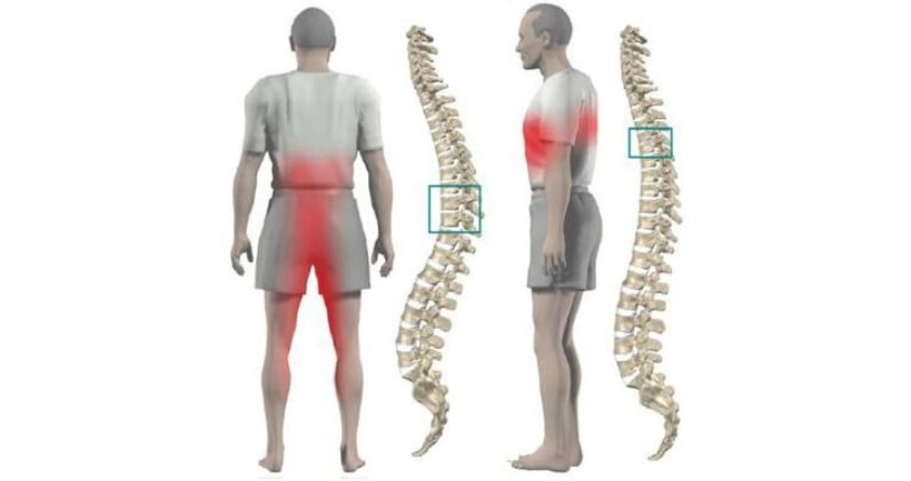 боли в теле и позвоночнике при остеохондрозе