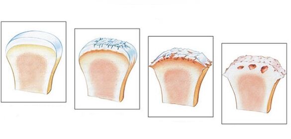 Здоровый голеностопный сустав и степень развития остеоартроза. 